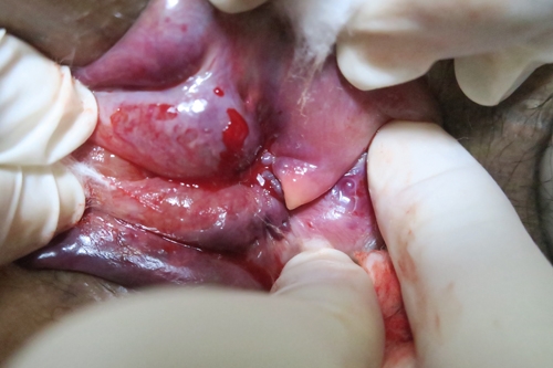 หูดหงอนไก่ (เชื้อไวรัส HPV ก่อมะเร็ง)