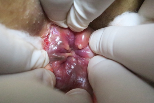 หูดหงอนไก่ (เชื้อไวรัส HPV ก่อมะเร็ง)